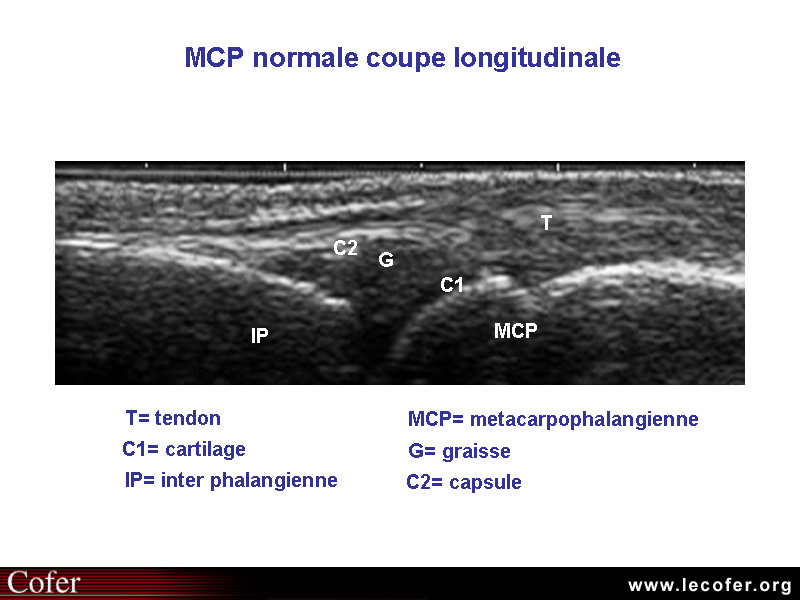 Échographie, articulation métacarpo-phalangienne normale, MCP