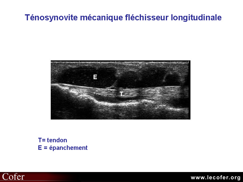 Ténosynovite, échographie