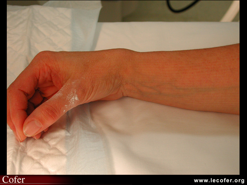 Fracture du poignet, déformation clinique