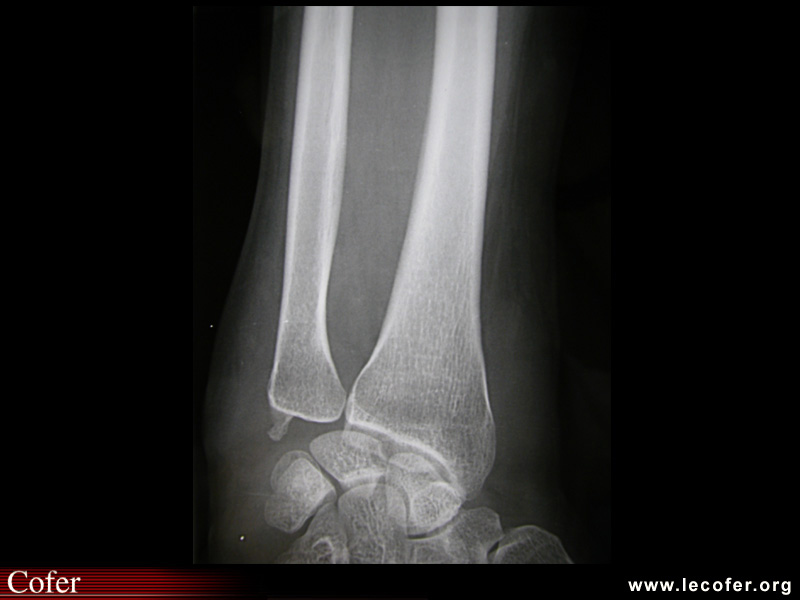 Radiographie normale du radius de face