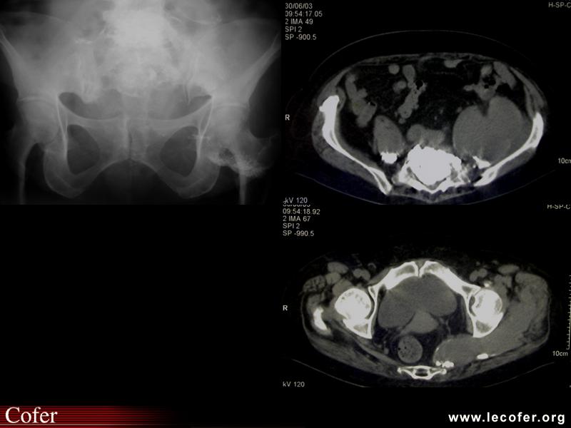 Tuberculose osseuse : abcès du psoas et du sacrum