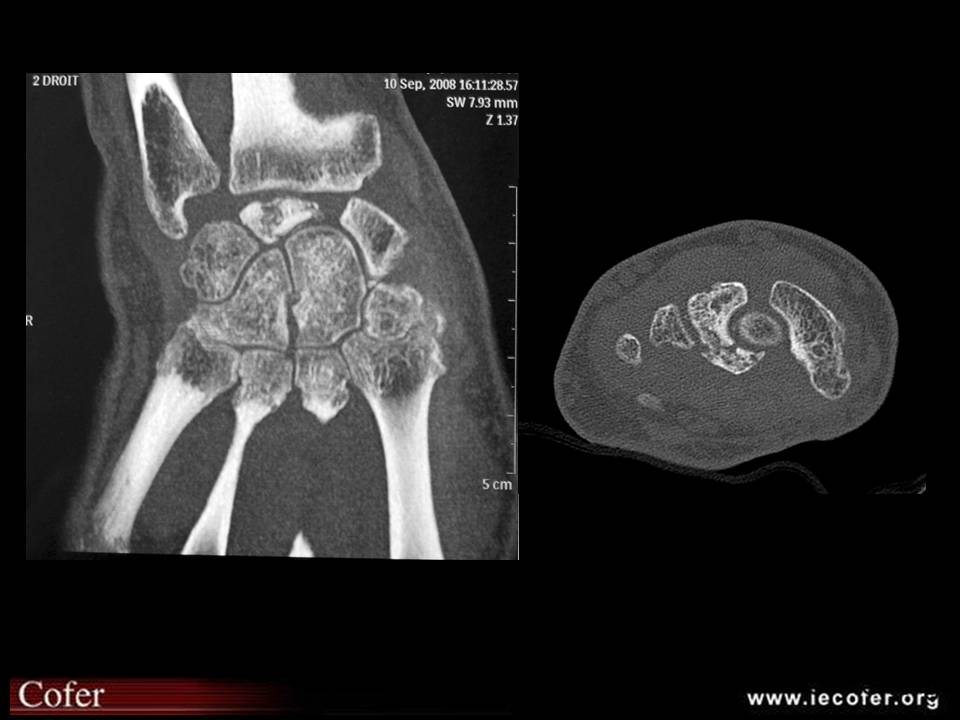 ostéonécrose post-traumatique du lunatum : TDM