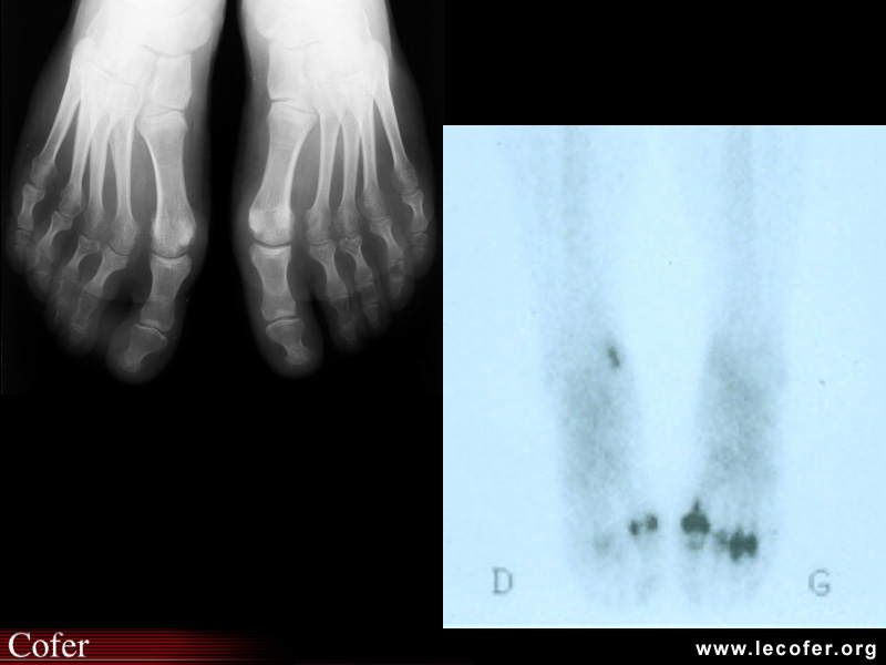 Spondylarthrite ankylosante / SpA / pelvispondylite rhumatismale / spondylarthropathie : atteinte des pieds et avant-pieds