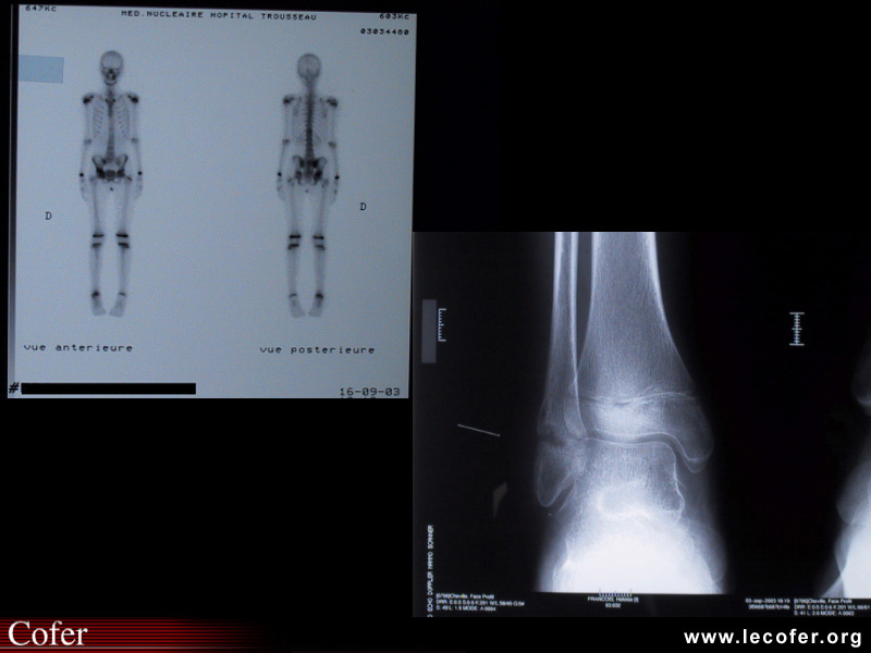 Ostéite chronique récurrente multifocale : atteinte de la cheville. Pédiatrie.