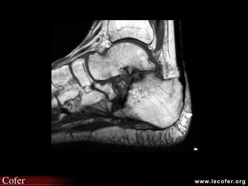 Arthropathie post-traumatique sous-talienne