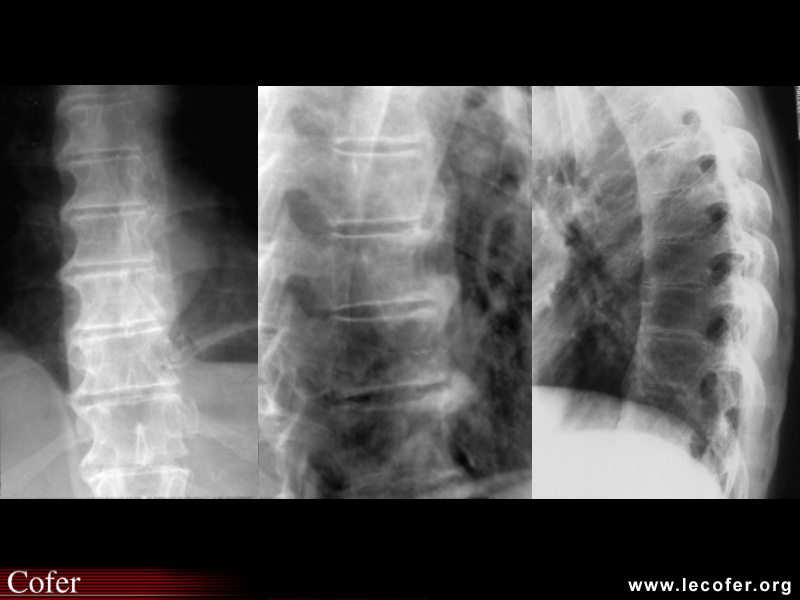 Spondylarthrite ankylosante / SpA / pelvispondylite rhumatismale / spondylarthropathie