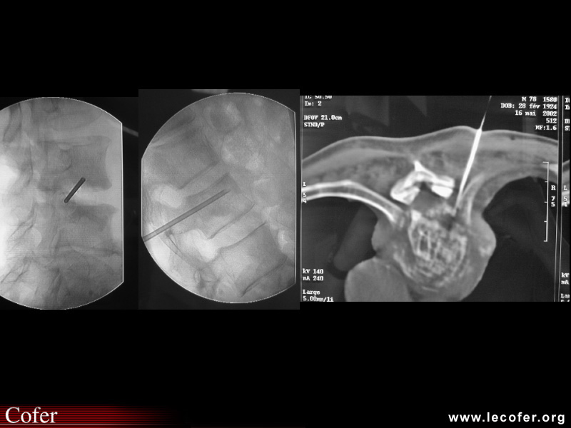 Spondylodiscite infectieuse : ponction discale