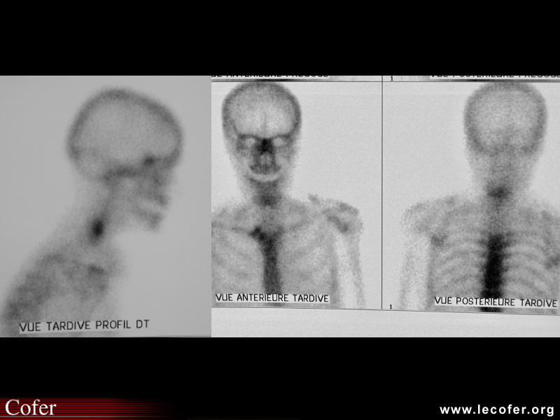 Spondylodiscite infectieuse