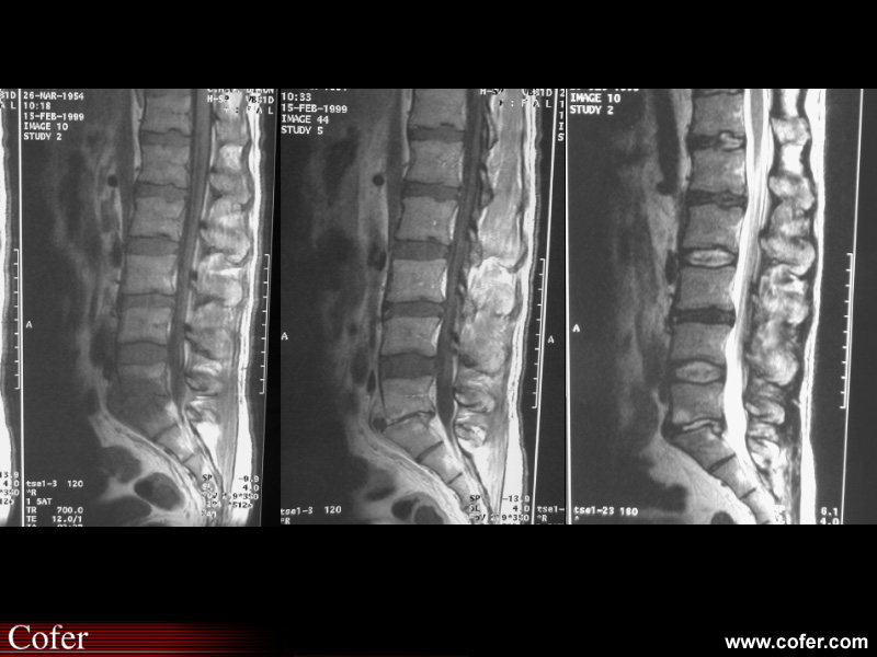 Spondylodiscite infectieuse