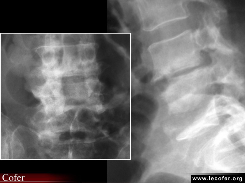 Mal de Pott, tuberculose vertébrale, tuberculose ostéoarticulaire : ostéolyse