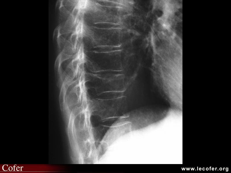 Fracture vertébrale de grade 2 du rachis dorsal