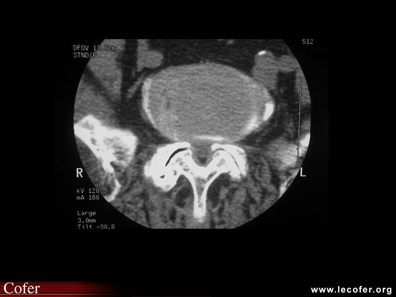 Canal lombaire étroit par arthrose interapophysaire postérieure