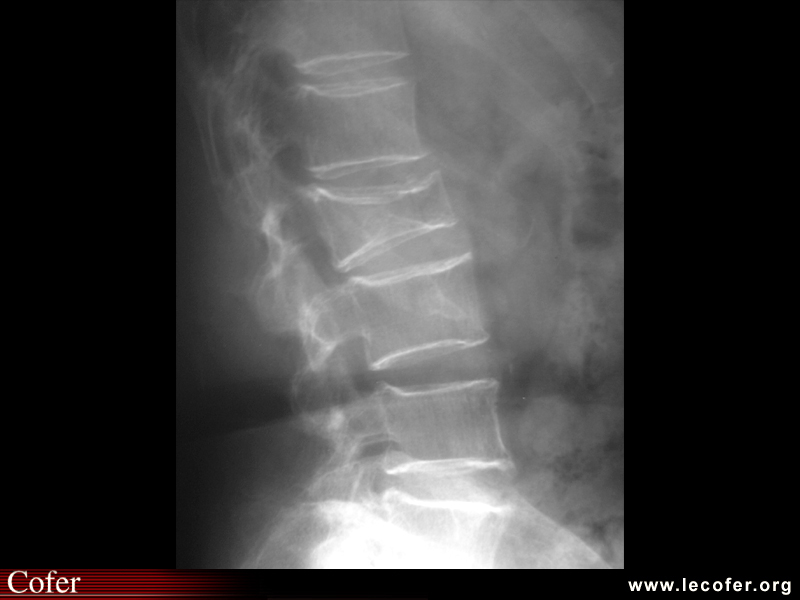 Fracture vertébrale de grade 3 du rachis lombaire