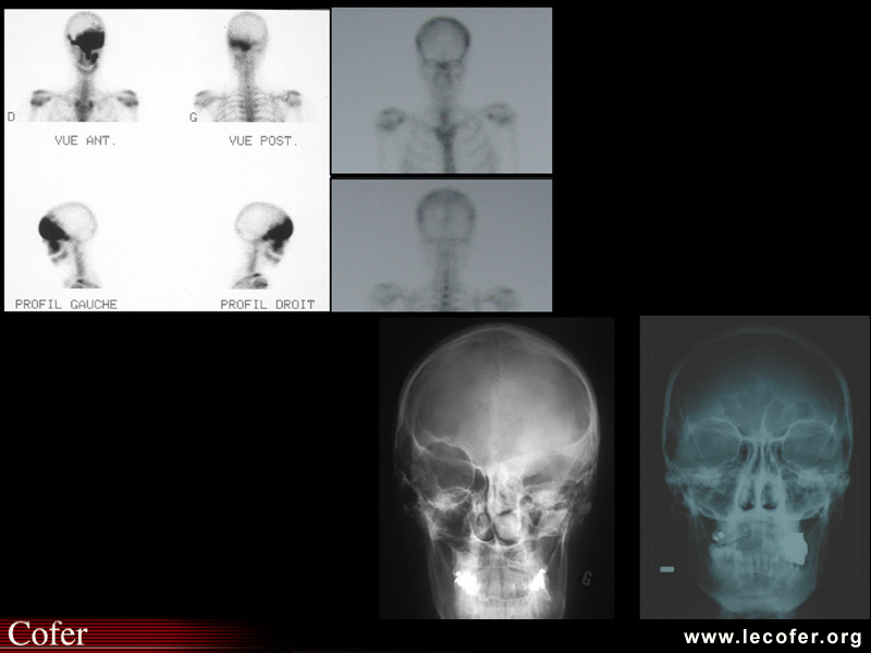 Maladie de Paget : scintigraphie osseuse avec atteinte isolée de C5