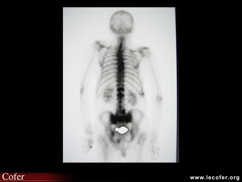 Fracture du sacrum, aspect scintigraphique d’une fracture du sacrum par insuffisance osseuse