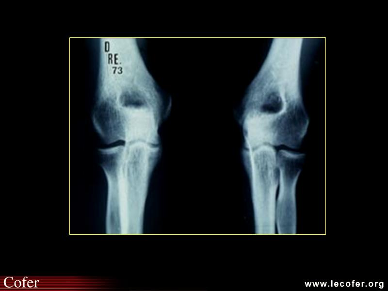 Évolution radiologique dans la polyarthrite rhumatoïde : radiographies du coude normales au départ de la maladie