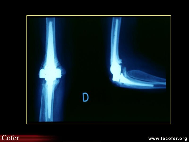 Évolution radiologique au cours de la polyarthrite rhumatoïde : prothèse totale du coude droit quelques années plus tard