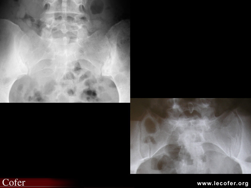 Spondylarthrite ankylosante / SpA / pelvispondylite rhumatismale / spondylarthropathie