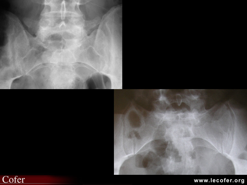 Spondylarthrite ankylosante / SpA / pelvispondylite rhumatismale / spondylarthropathie