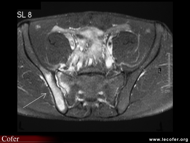 Spondylarthrite ankylosante / SpA / pelvispondylite rhumatismale / spondylarthropathie