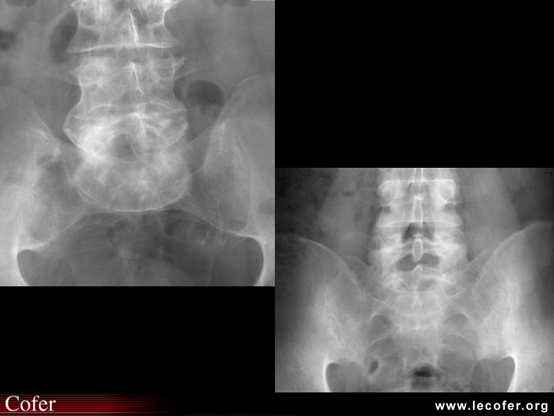 Spondylarthrite ankylosante / SpA / pelvispondylite rhumatismale / spondylarthropathie : diagnostic différentiel