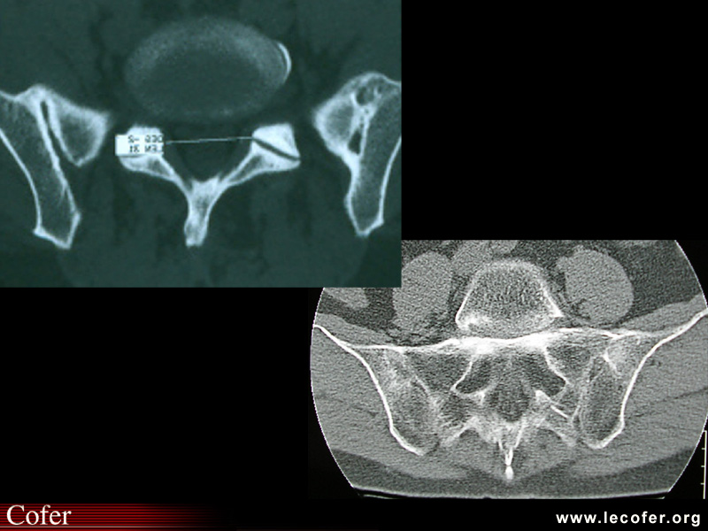 Spondylarthrite ankylosante / SpA / pelvispondylite rhumatismale / spondylarthropathie : Diagnostic différentiel