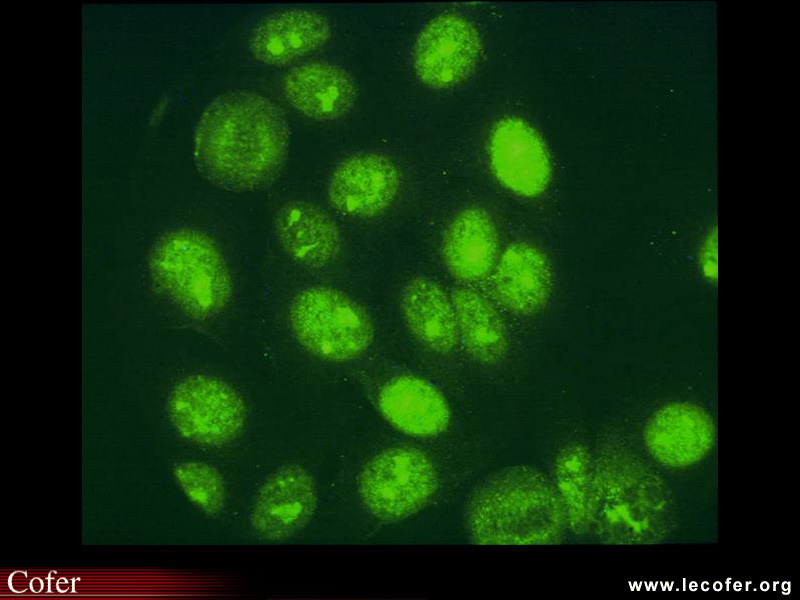 Lupus systémique, lupus érythémateux disséminé : anomalies immunologiques au cours du lupus systémique