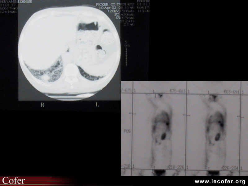 Sclérodermie systémique : Atteinte pulmonaire