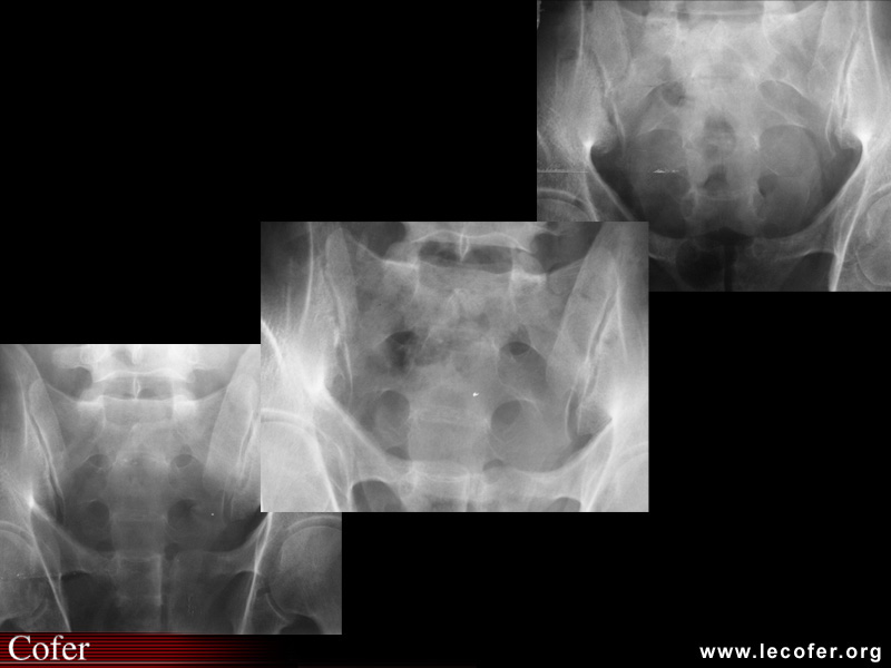 Sacroiliite infectieuse. Évolution temporelle de la radiographie