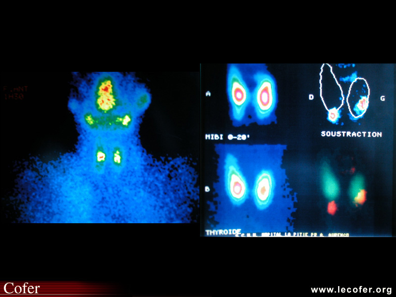 Hyperparathyroïdie