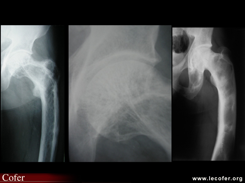 Dysplasie fibreuse : radiographie de lésions caractéristiques sur le fémur