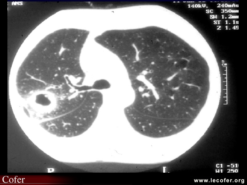 Scanner. Nodule pulmonaire excavé