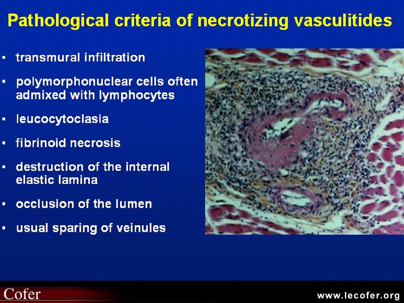 Vascularites, critères anatomo-pathologiques des vascularites nécrosantes