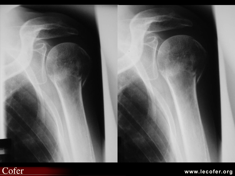 Fracture du col chirurgical de l'humérus, fracture de l'humérus)