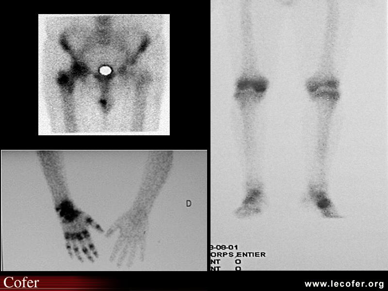 Algoneurodystrophie, algodystrophie : scintigraphie osseuse