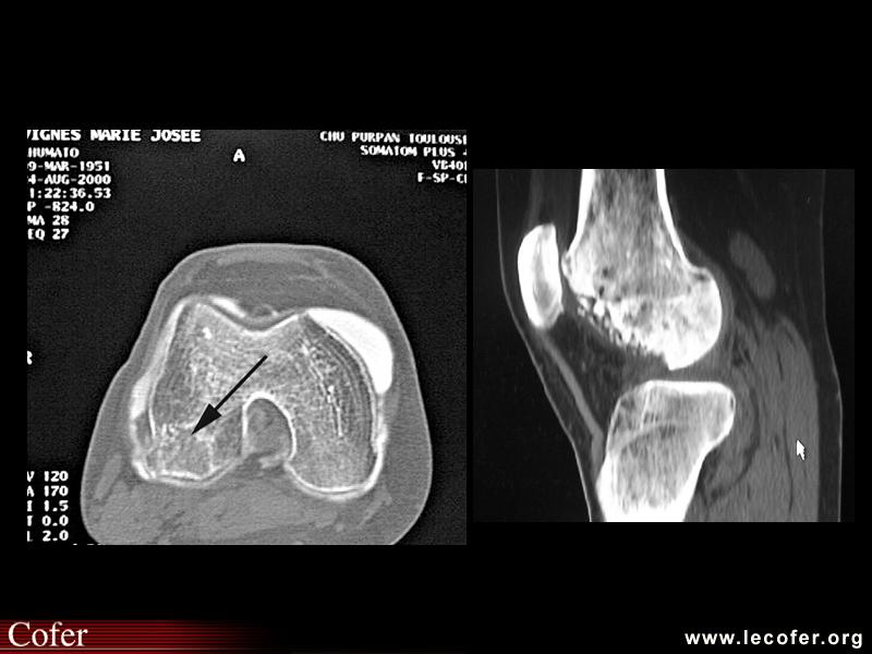 Ostéonécrose du condyle fémoral : tomodensitométrie