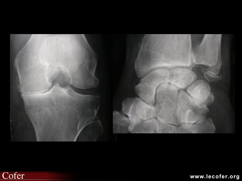 Chondrocalcinose et hyperparathyroïdie