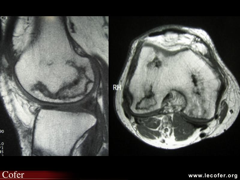 Ostéonécrose du genou, ostéonécrose du condyle