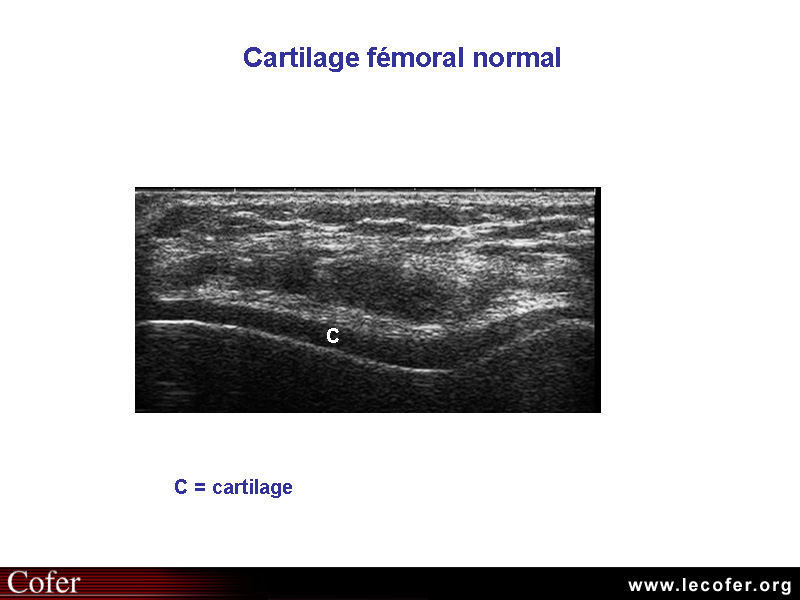 Cartilage normal, échographie