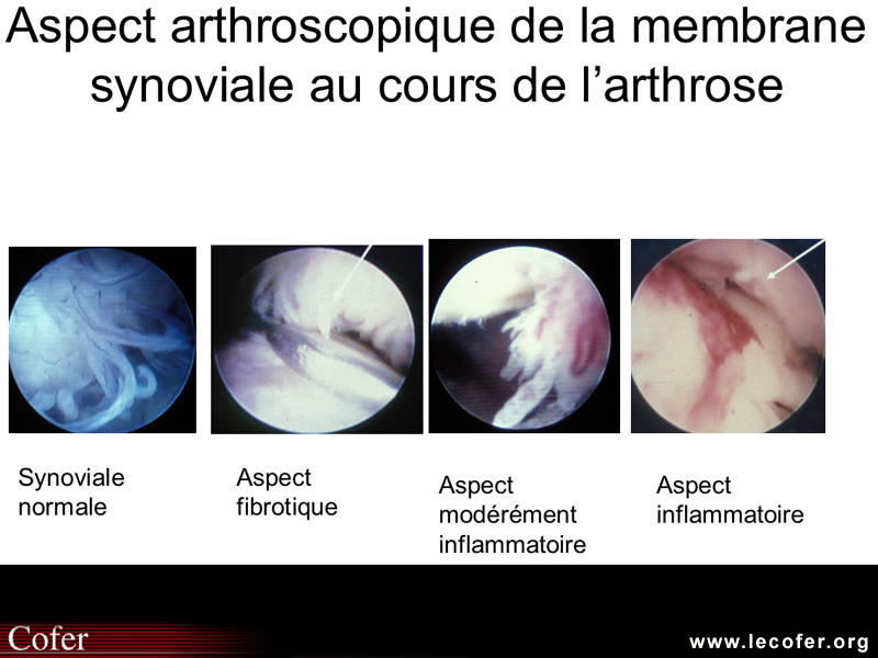 Synovite: vue arthroscopique.