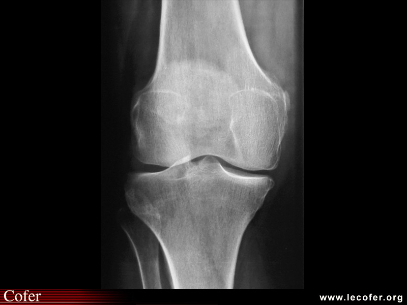 Gonarthrose fémoro-tibiale interne modérée face