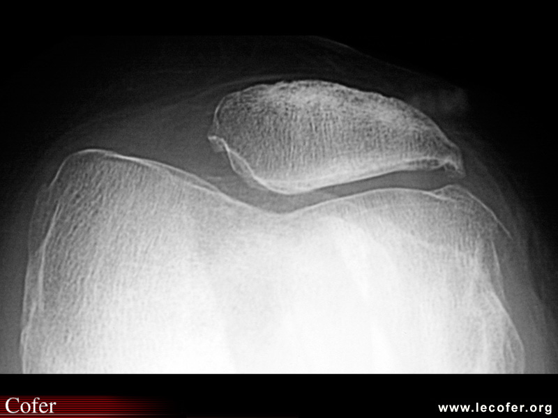 Gonarthrose fémoro-patellaire externe : radiographie