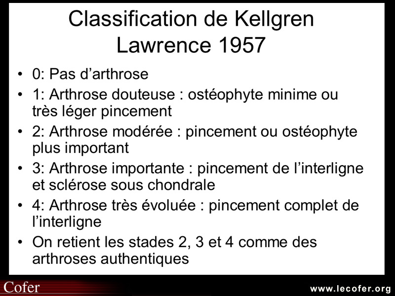 Gonarthrose : la classification de Kellgren et Lawrence