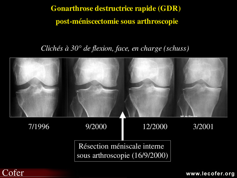 Gonarthrose, profil évolutif de la gonarthrose : forme rapide