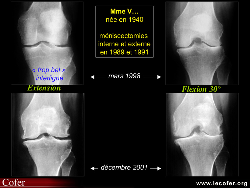 Gonarthrose, profil évolutif de la gonarthrose : forme lente