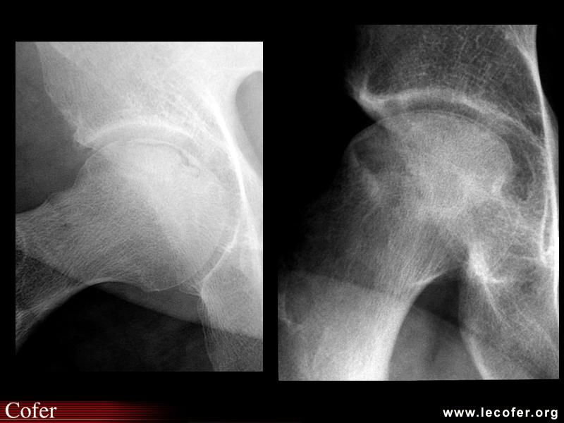 OstéoNécrose Aseptique de Hanche (ONAH) : Radiographies : Stade 3 de la classification d’Arlet et Ficat