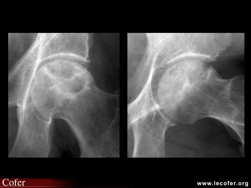OstéoNécrose Aseptique de Hanche (ONAH) : Radiographies : Stade 3 de la classification d’Arlet et Ficat