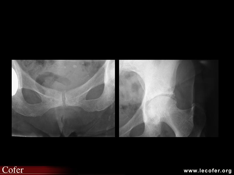 Chondrocalcinose articulaire de la symphyse pubienne et de la coxo-fémorale