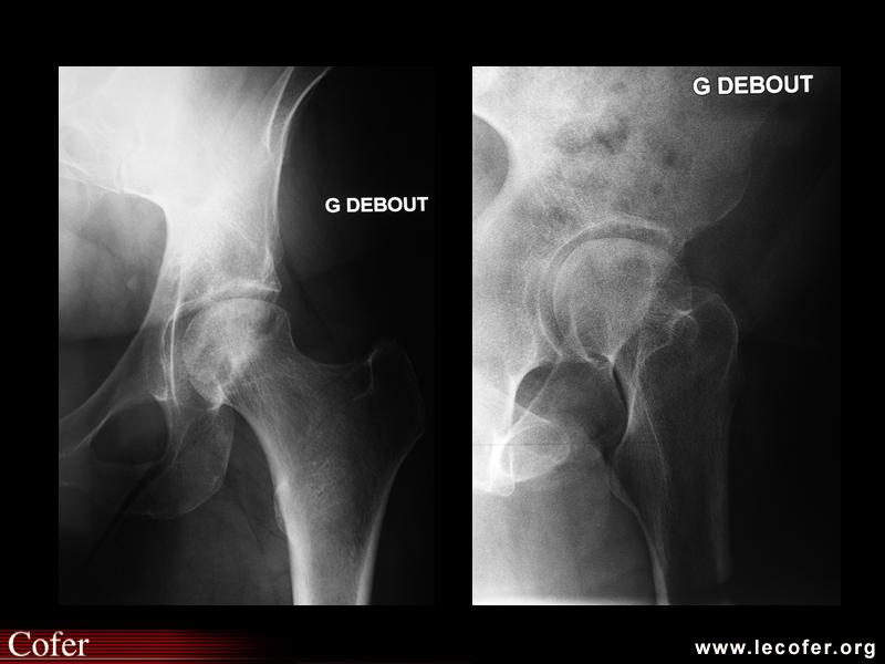 Ostéonécrose aseptique de la tête fémorale gauche