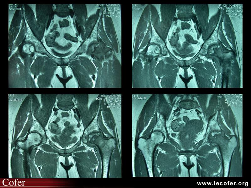 Ostéonécrose aseptique des deux têtes fémorales